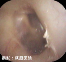 図1:正常鼓膜