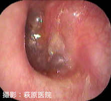 図2:急性中耳炎