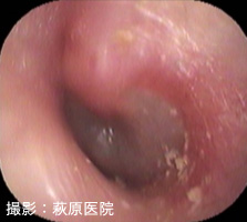 図3:急性中耳炎