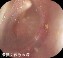 図4:滲出性中耳炎