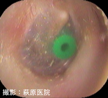 図５：鼓室換気チューブ術後