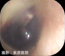 図6:難治性滲出性中耳炎(コレステリン肉芽腫)