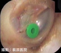 図７：鼓膜換気チューブ術後