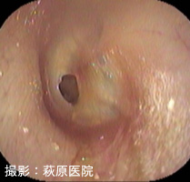 図８：慢性穿孔性中耳炎