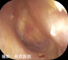 図9:鼓膜穿孔閉鎖術後